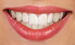 What Are Lingual Braces?  Jorgensen Orthodontics - Affordable Care